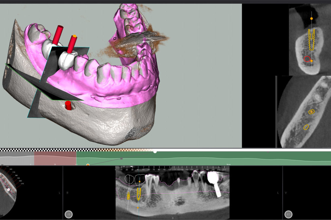 Implantologie 3D